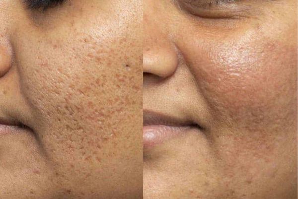 Microneedling with Exosomes