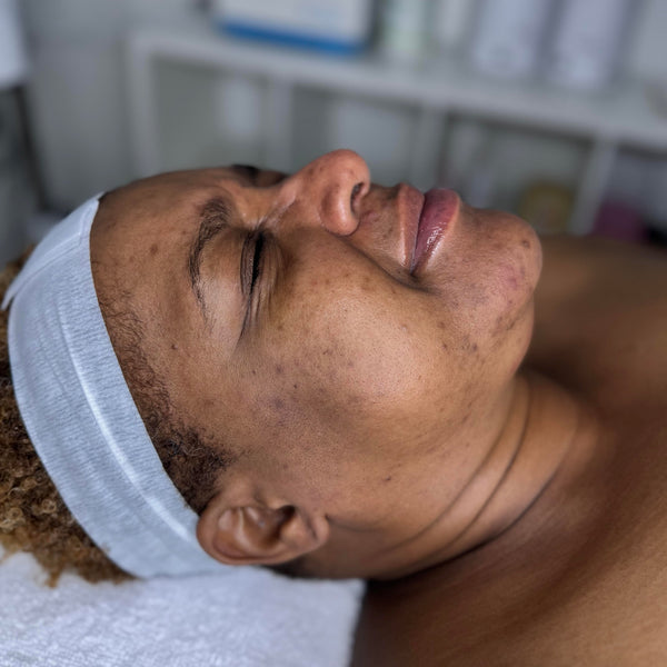 Acne Boot Camp Program