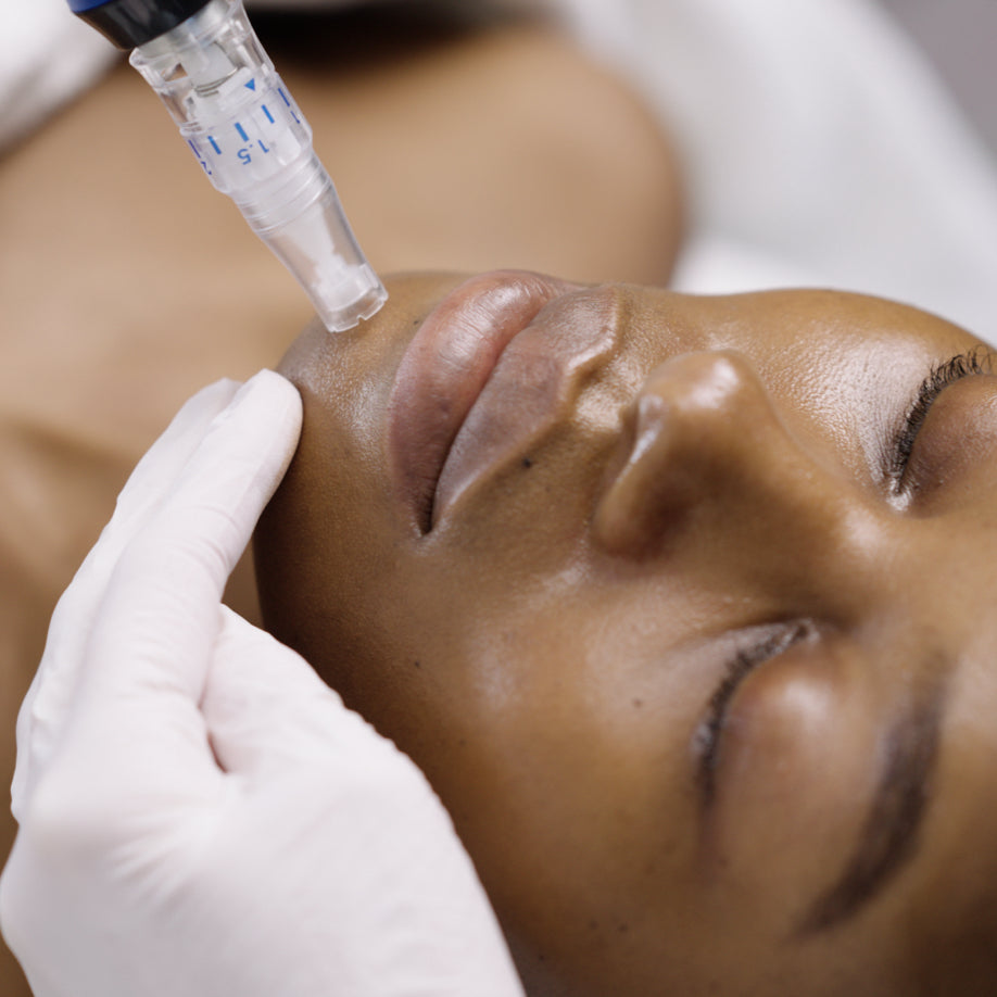 Microneedling with Exosomes