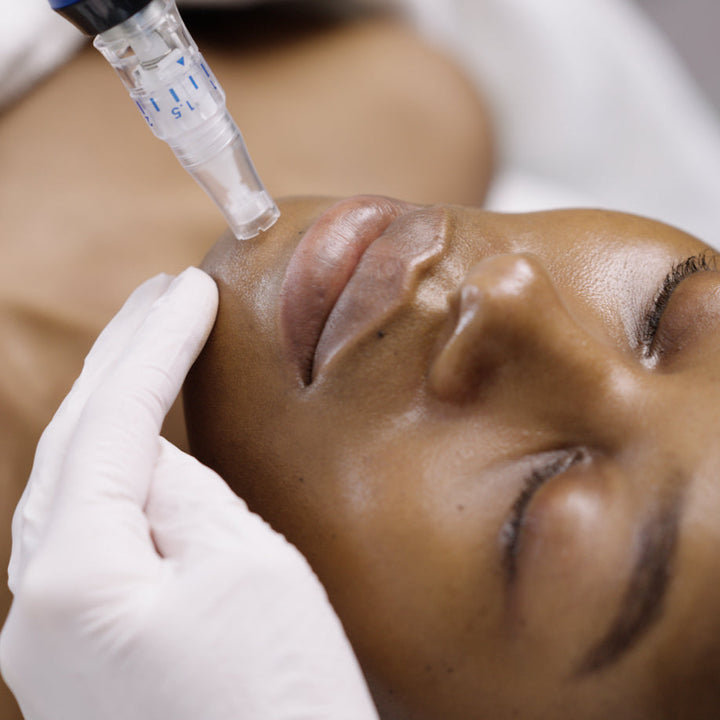Microneedling with Exosomes