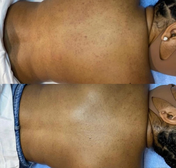 Back Peel